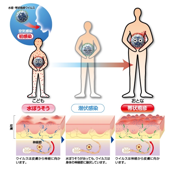 いつまで 帯状 疱疹 痛み