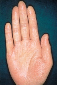 荒れる 手のひら 手や指の皮がボロボロむける５つ原因と対策！病気の可能性もあり？